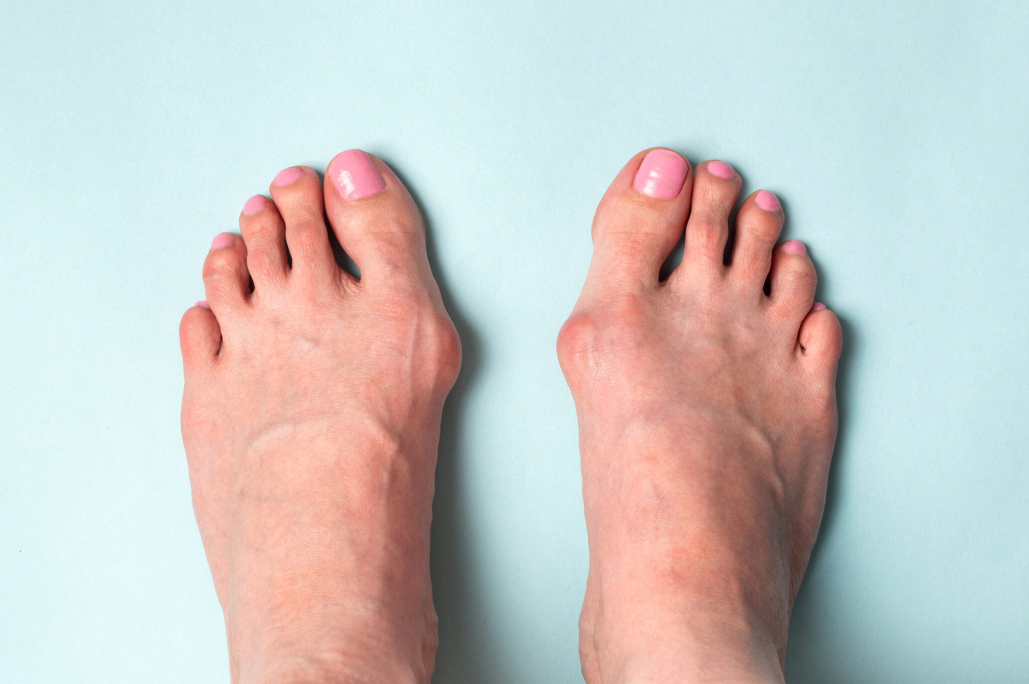 Hallux Valgus Bunions Sajid Shariff