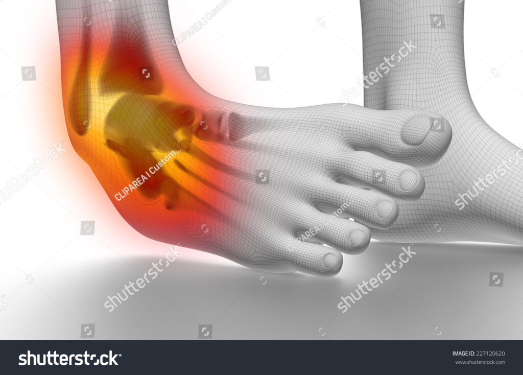 ankle_sprains1